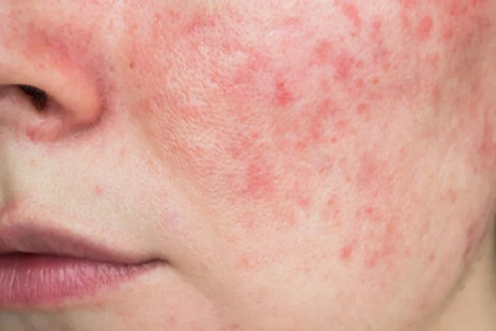 Rosacea verwijderen bij Yourskin in Apeldoorn