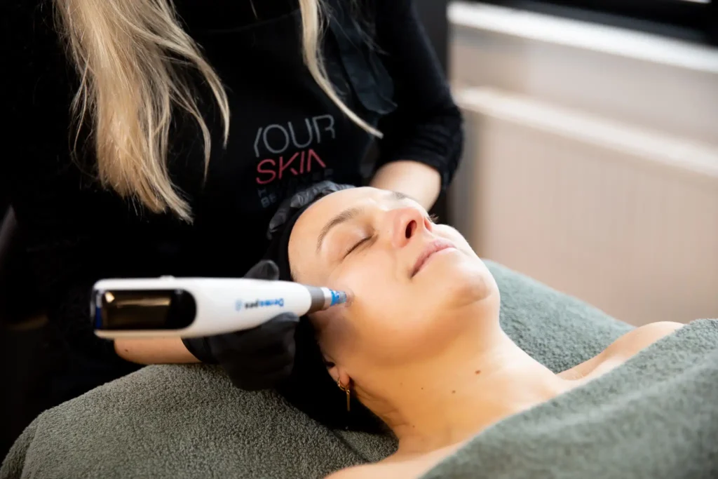 Microneedling voor huidverbetering bij YOURSKIN Apeldoorn