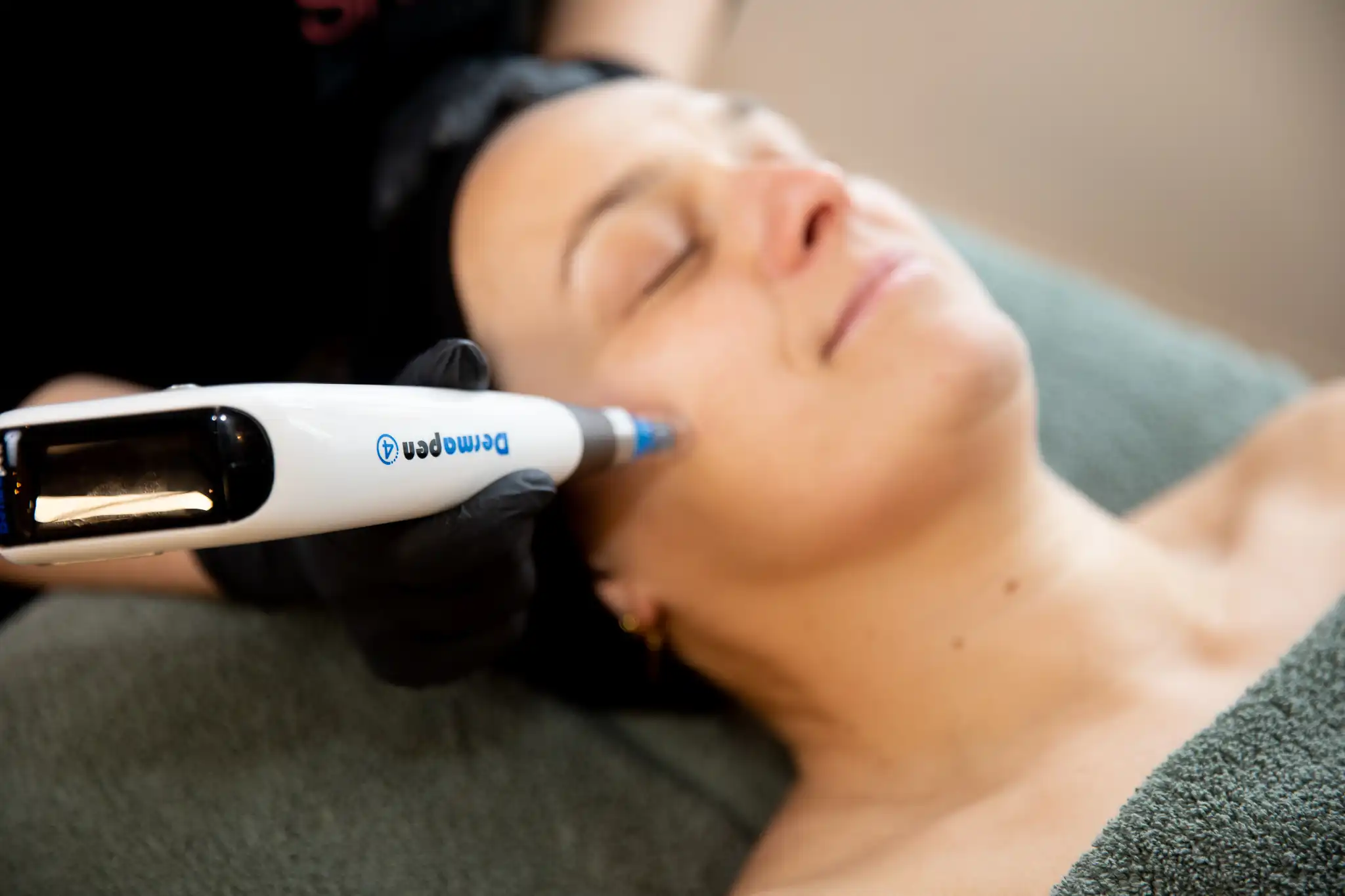 Microneedling behandeling in Apeldoorn met Dermapen4