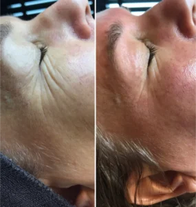 Voor en na bindweefselmassage gezicht bij schoonheidssalon Apeldoorn