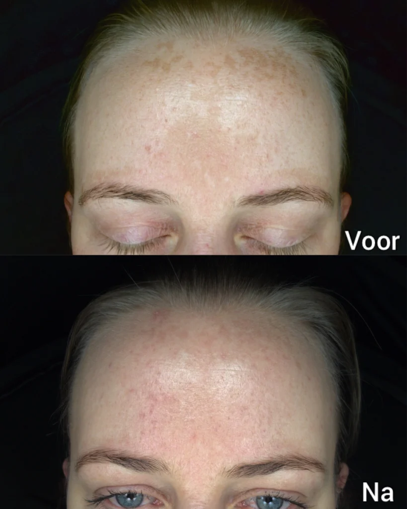 Voor en na pigmentbehandeling bij YOURSKIN Apeldoorn