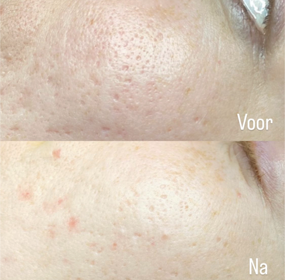 Voor en na acnebehandeling bij YOURSKIN in Apeldoorn