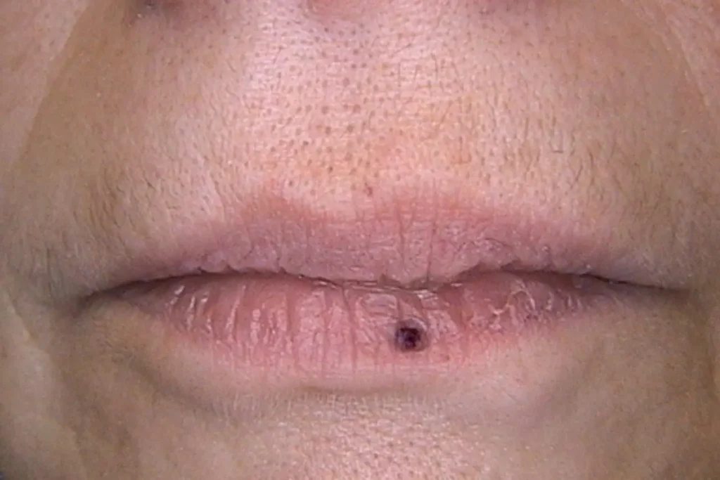 voor vaatlaser lip